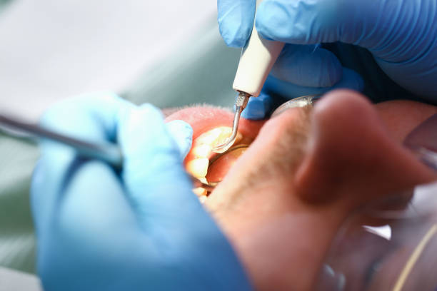 Best Emergency Root Canal Treatment in Chleston, AR